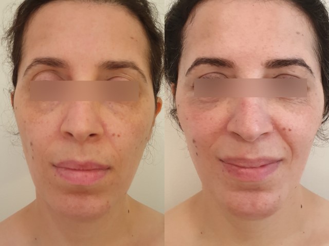 Lipofilling du visage, cas 8, photographie avant et après