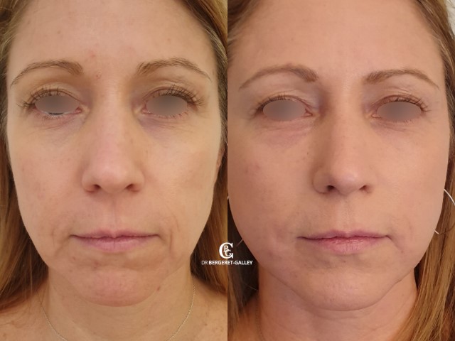Lipofilling du visage, cas 9, photographie avant et après