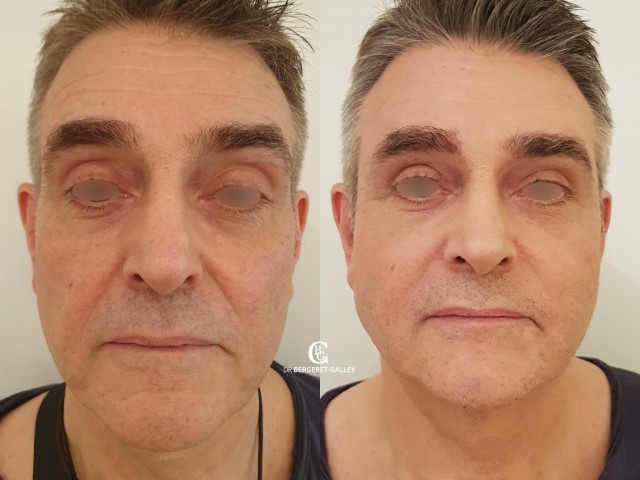 Lipofilling du visage, cas 10, photographie avant et après