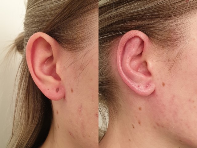 Oreilles (otoplastie), cas 1, photographie avant et après