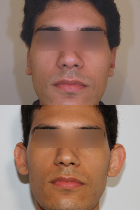 Oreilles (otoplastie), cas 5, photographie avant et après