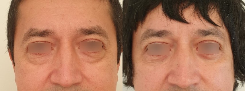 Paupières (blépharoplastie), cas 1, photographie avant et après