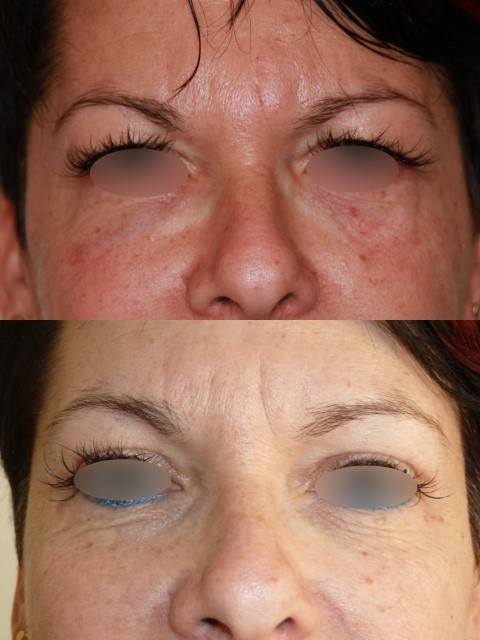 Paupières (blépharoplastie), cas 2, photographie avant et après