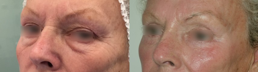 Paupières (blépharoplastie), cas 3, photographie avant et après