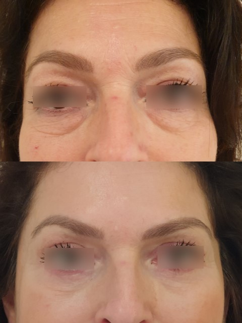 Paupières (blépharoplastie), cas 4, photographie avant et après