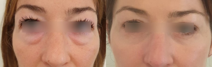 Paupières (blépharoplastie), cas 5, photographie avant et après