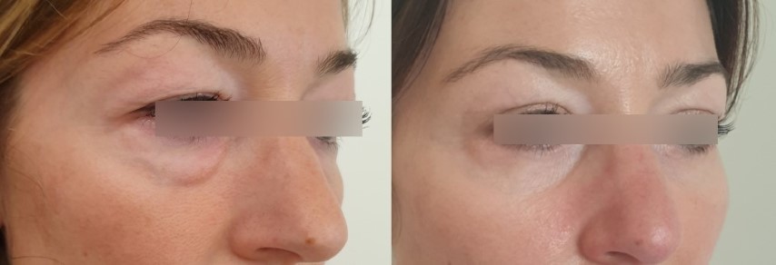 Paupières (blépharoplastie), cas 6, photographie avant et après