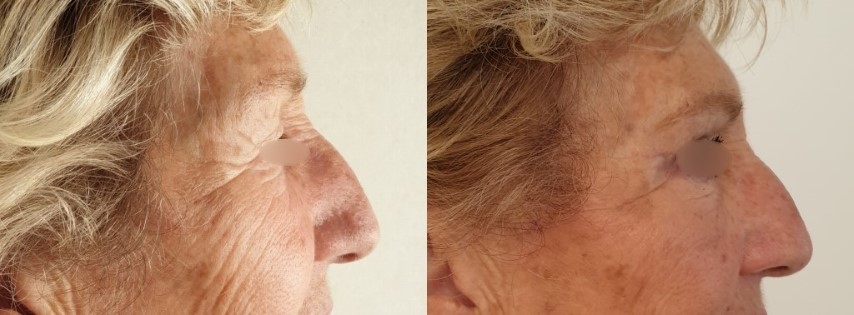 Paupières (blépharoplastie), cas 7, photographie avant et après