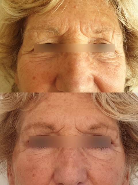 Paupières (blépharoplastie), cas 8, photographie avant et après