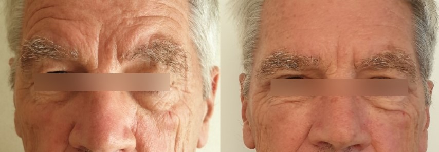Paupières (blépharoplastie), cas 9, photographie avant et après