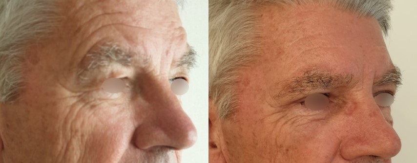 Paupières (blépharoplastie), cas 10, photographie avant et après