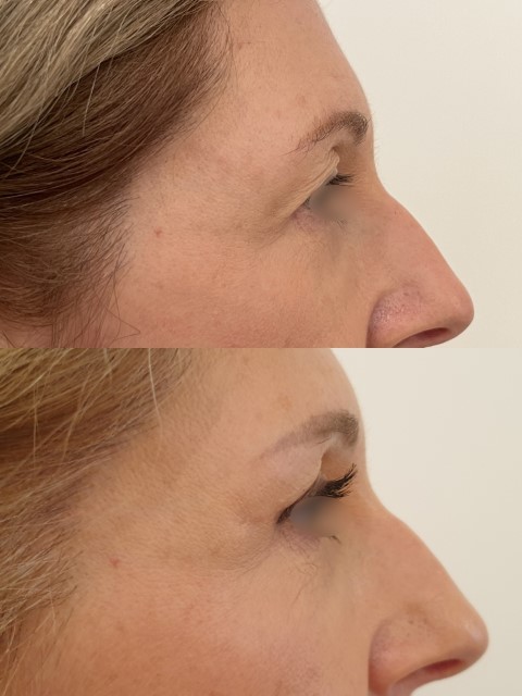 Paupières (blépharoplastie), cas 11, photographie avant et après