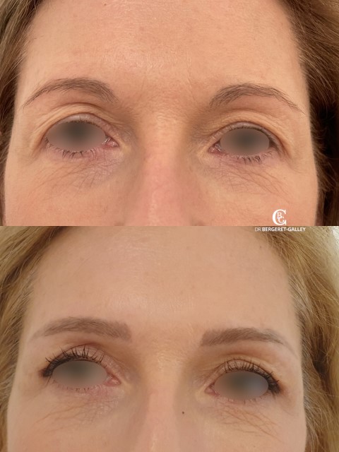 Paupières (blépharoplastie), cas 12, photographie avant et après