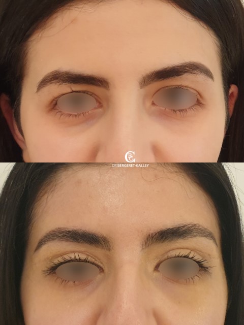 Paupières (blépharoplastie), cas 13, photographie avant et après