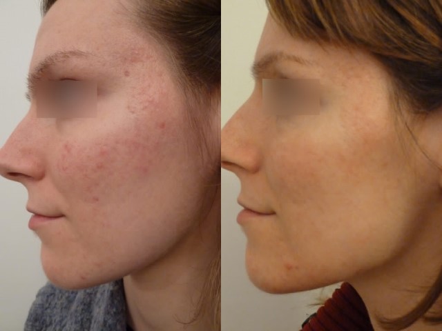 Peeling, cas 1, photographie avant et après