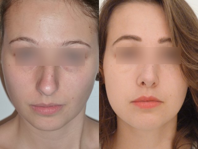 Rhinoplastie, cas 1, photographie avant et après