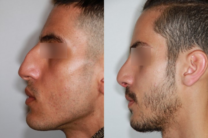 Rhinoplastie, cas 2, photographie avant et après