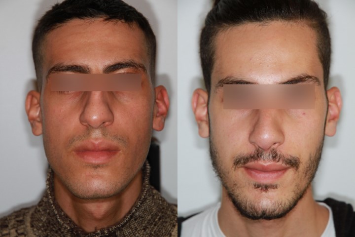 Rhinoplastie, cas 3, photographie avant et après