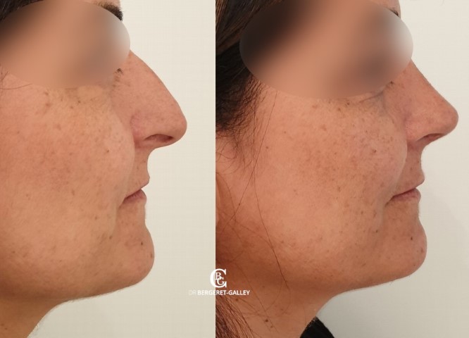 Rhinoplastie, cas 4, photographie avant et après