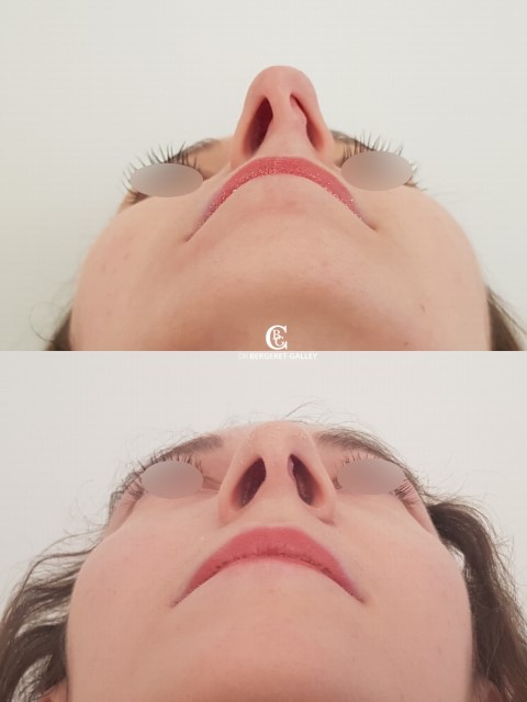 Rhinoplastie, cas 5, photographie avant et après