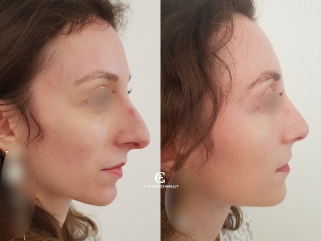 Rhinoplastie, cas 6, photographie avant et après