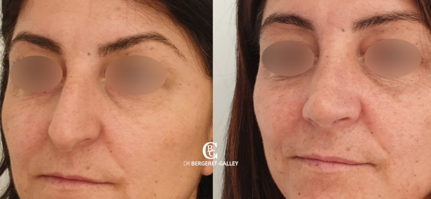 Rhinoplastie, cas 7, photographie avant et après