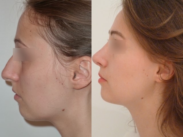 Rhinoplastie, cas 8, photographie avant et après