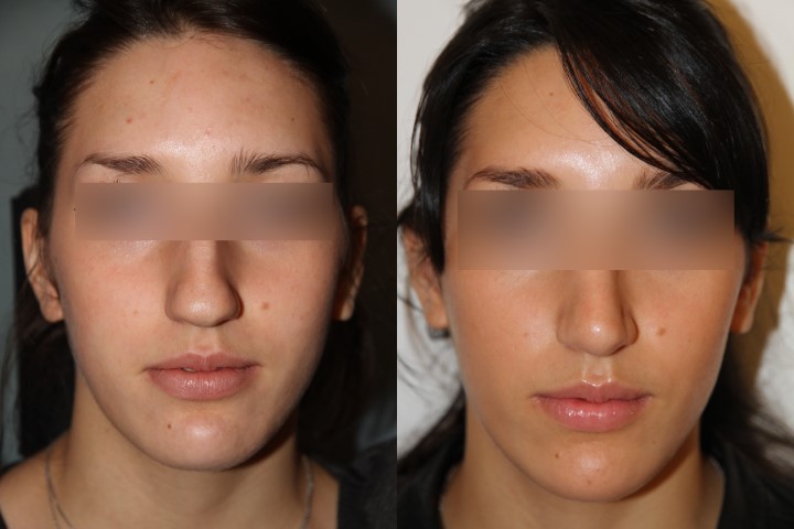 Rhinoplastie, cas 9, photographie avant et après