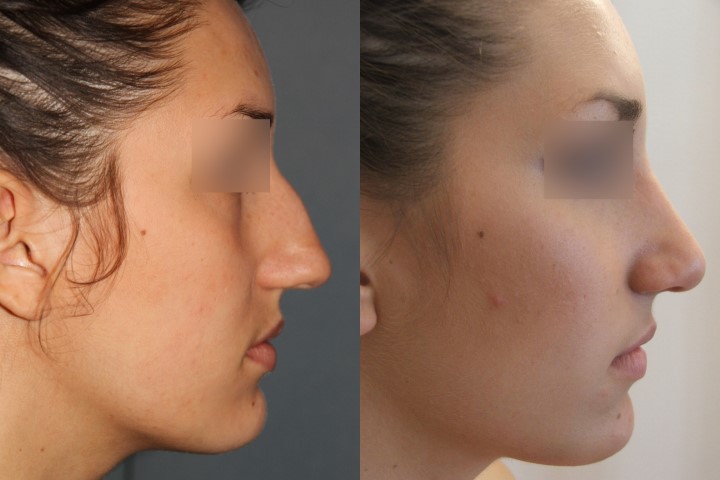 Rhinoplastie, cas 10, photographie avant et après