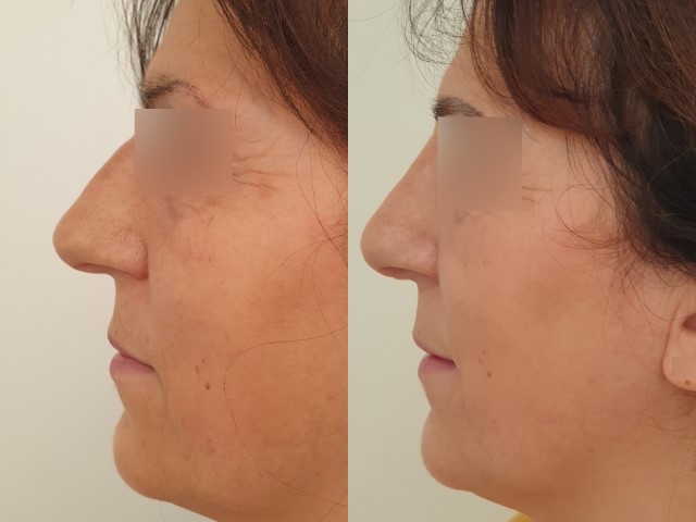 Rhinoplastie, cas 11, photographie avant et après