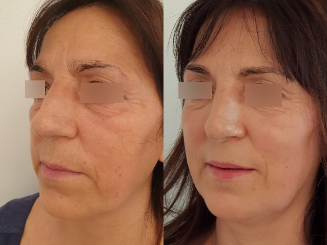 Rhinoplastie, cas 12, photographie avant et après