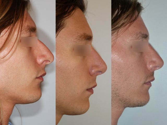 Rhinoplastie, cas 13, photographie avant et après