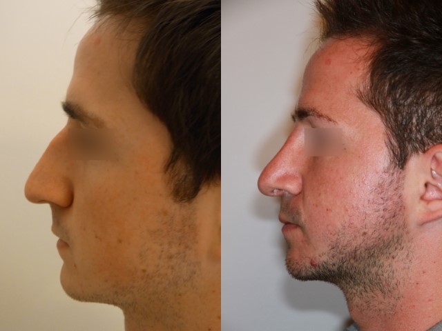Rhinoplastie, cas 14, photographie avant et après