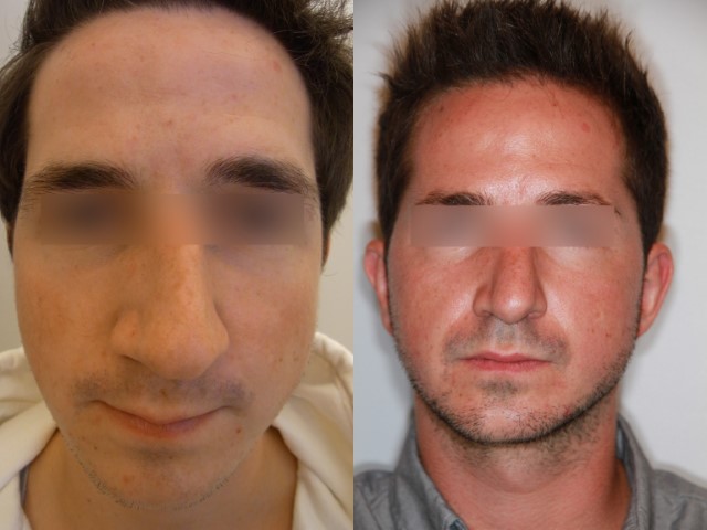 Rhinoplastie, cas 15, photographie avant et après
