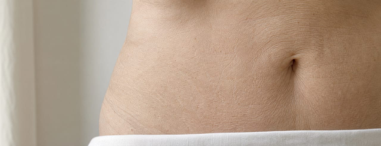 Région péri-ombilicale d'une femme debout, texture cutanée et vergetures fines, partiellement voilée par un linge de coton blanc.